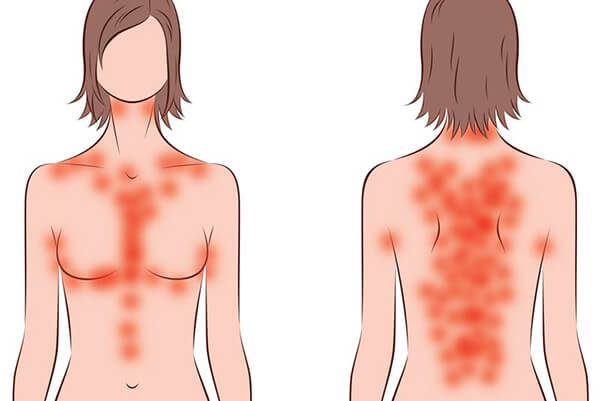 Phát ban keto thường xuất hiện nhiều ở vùng cổ, ngực và lưng