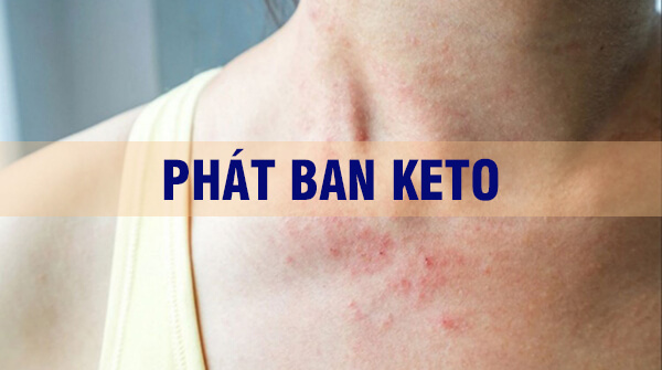 Phát ban keto