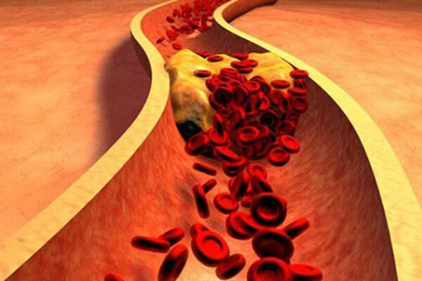 Chế độ ăn keto giúp cải thiện cholesterol là dấu hiệu tích cực đối với bệnh tiểu đường