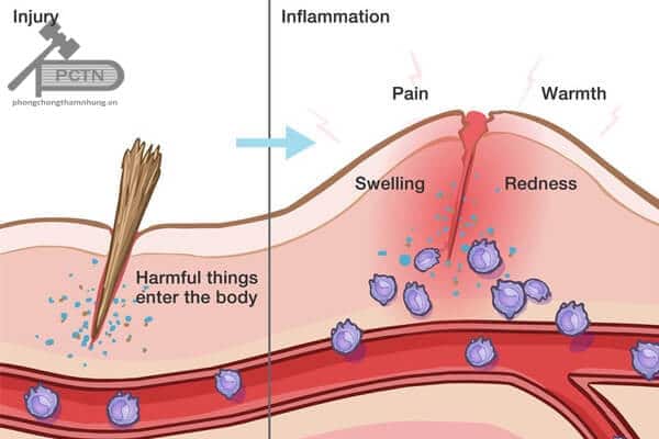 Viêm gồm có viêm cấp tính và viêm mạn tính