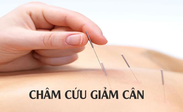 Châm cứu giảm béo